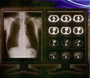 فيلم Ray Clear Digital X Ray ، فيلم الشفافية بالليزر الطبي Konida