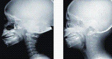 تغطية عالية بالحبر X التصوير الشعاعي ، 35 × 43 سم ليزر طبي فيلم الأشعة السينية