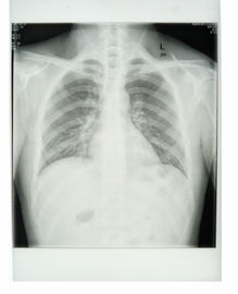 مخصص 25 سم * 30 سم قاعدة بيضاء ورقة الأشعة السينية فيلم طبي مع مواد PET