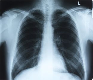 التصوير الطبي بالليزر الجاف X Ray لـ AGFA 5300/5302/5500 ، 35 سم × 43 سم