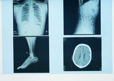 التصوير التشخيصي المتين للأشعة السينية ، ورق طبي 32 سم × 43 سم ليزر أزرق فيلم الأشعة السينية