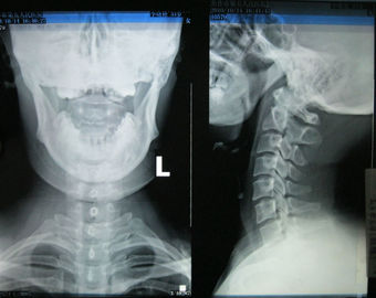 Good price 10in * 14in Konida Medical التصوير الجاف السينمائي KND-F لفوجي 3000 ، 2000 ، 1000 الانترنت