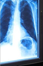 فيلم التصوير الطبي الجاف بالأشعة السينية الزرقاء 11in x 17in للطابعة الحرارية